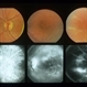 Eales Disease Eales Disease